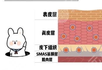 筋膜提升術(shù)