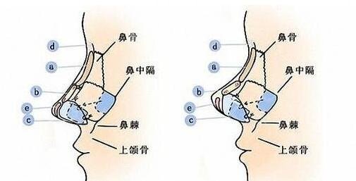成都陳倩隆鼻怎么樣？醫(yī)生個人信息、手術(shù)風(fēng)格偏向、做鼻子評價新版發(fā)布~