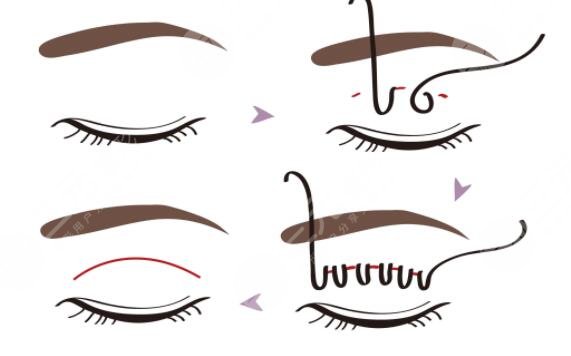 雙眼皮手術(shù)術(shù)前要注意什么?