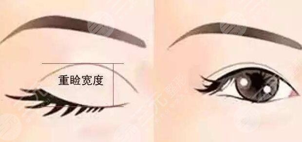 雙眼皮手術(shù)術(shù)后要怎么護(hù)理?