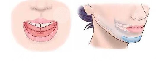 墊下巴多長時(shí)間恢復(fù)正常?