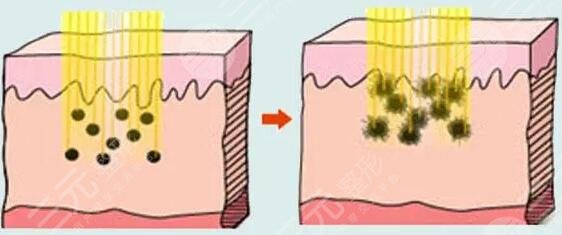 鐳射激光嫩膚效果怎么樣?
