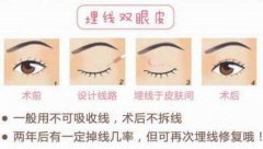 埋線雙眼皮多久恢復(fù)正常？靚眼攻略細(xì)說(shuō)術(shù)前術(shù)后的那些事！