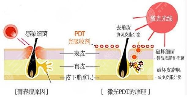 激光祛痘大概要多少錢
