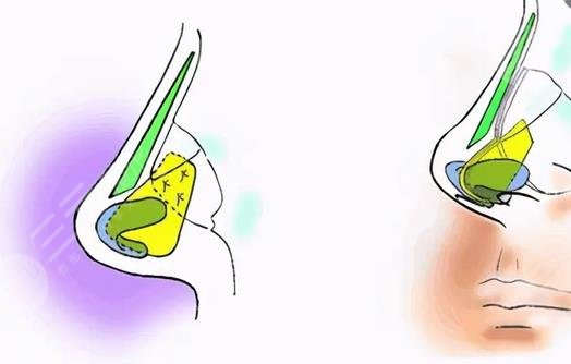 隆鼻有什么危害和后遺癥嗎？