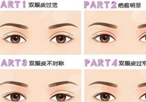 雙眼皮修復(fù)大概多少錢(qián)呢?