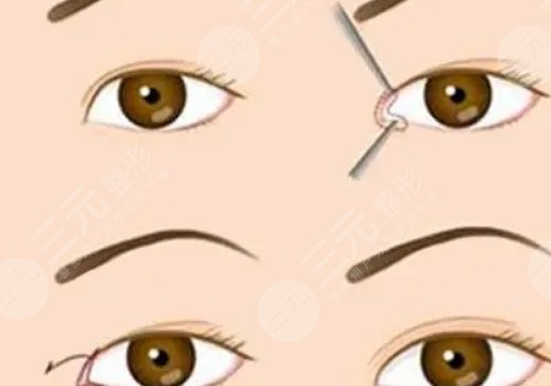 雙眼皮修復(fù)大概多少錢(qián)呢?