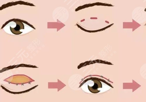 雙眼皮修復(fù)大概多少錢(qián)呢?