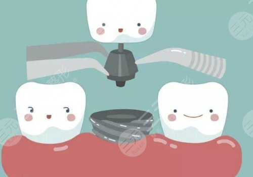 種植牙可以用社?？▓?bào)銷嗎？