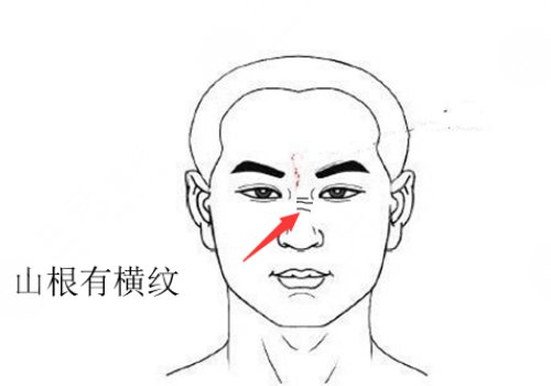 山根有橫紋是怎么回事？