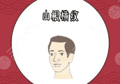 山根有橫紋是怎么回事？