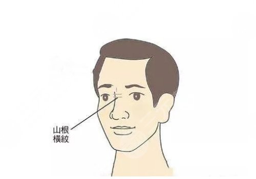 山根有橫紋是怎么回事？