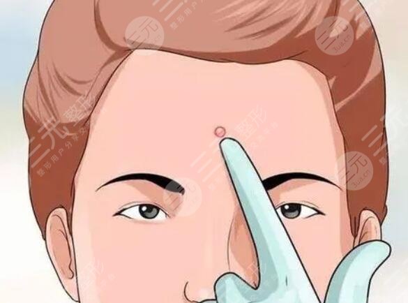 痘痘是什么原因?