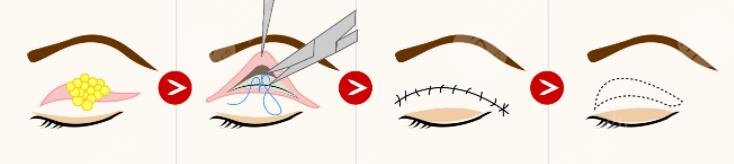 韓式眼部整形的注意事項
