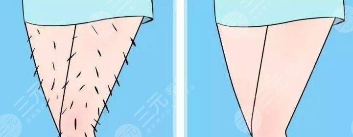 小腿激光脫毛的價(jià)格多少錢(qián)2023?