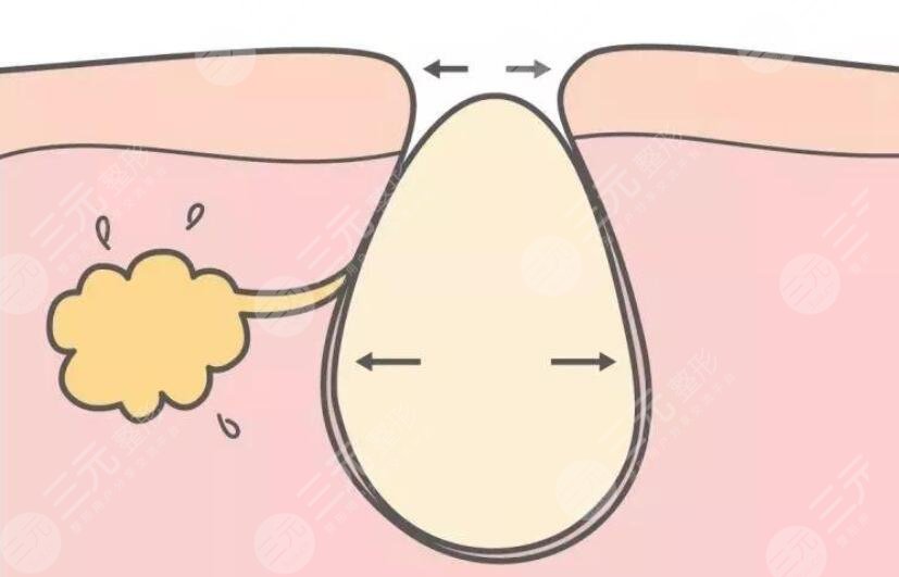 解讀！   激光緩解毛孔粗大