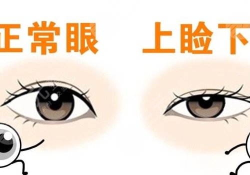 上瞼下垂矯正手術(shù)有風(fēng)險(xiǎn)嗎？