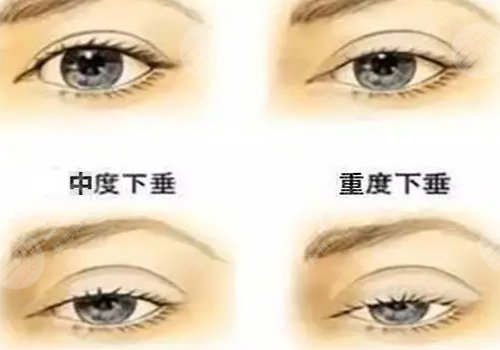 上瞼下垂矯正手術(shù)有風(fēng)險(xiǎn)嗎？