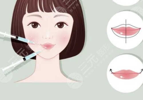 瑞蘭2號玻尿酸適合打哪里？