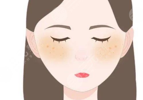 去除黃褐斑價格是多少？