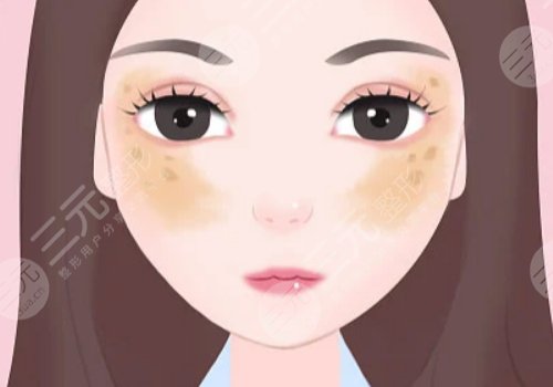 去除黃褐斑價格是多少？