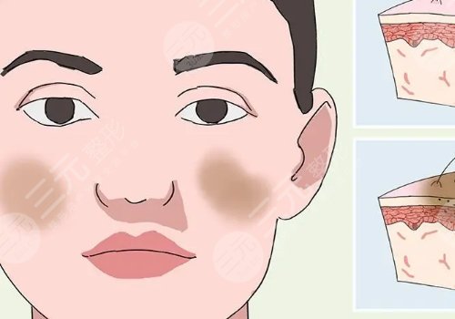 去除黃褐斑價格是多少？