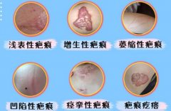 疤痕疙瘩的緩解辦法科普！3種方案修復(fù)皮膚~