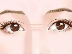 鼻梁紋怎么去除？3種方案分享，醫(yī)美除皺小課堂！