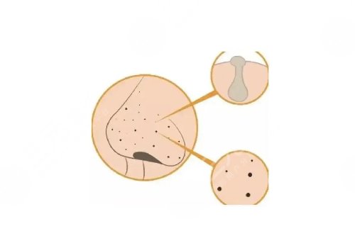 去黑頭收縮毛孔好的方法有哪些？