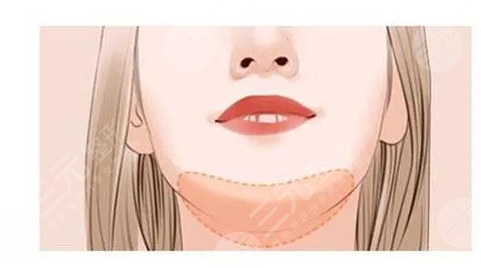 瑞蘭2號玻尿酸適合打哪里？