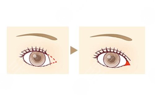 開內(nèi)眼角一般多少錢？