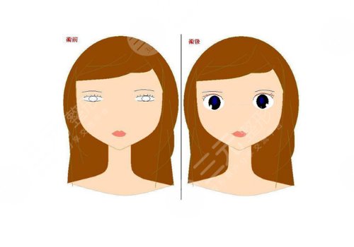 眼部整形有哪些項(xiàng)目？