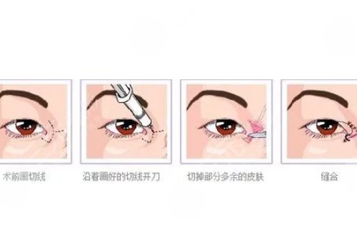 一般開(kāi)內(nèi)眼角多少錢(qián)?