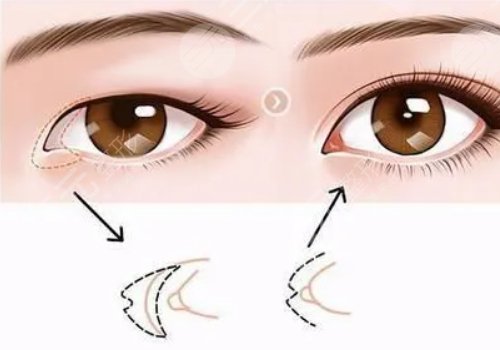 一般開(kāi)內(nèi)眼角多少錢(qián)?