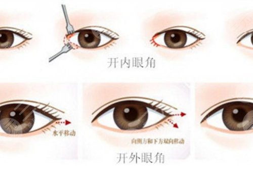 一般開(kāi)內(nèi)眼角多少錢(qián)?