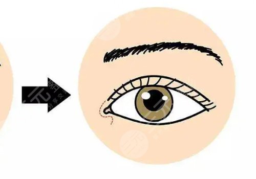 一般開(kāi)內(nèi)眼角多少錢(qián)?