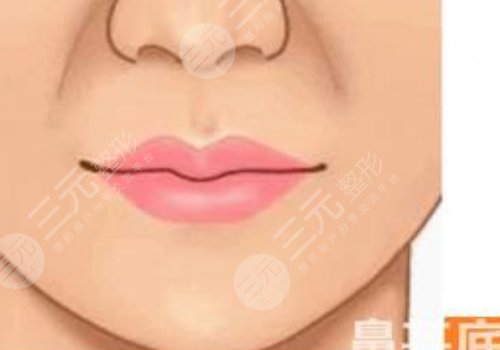 鼻基底注射玻尿酸會移位嗎？