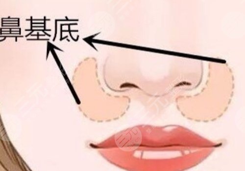 鼻基底注射玻尿酸會移位嗎？