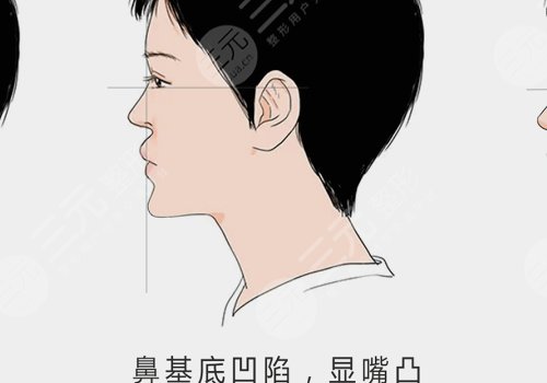 鼻基底注射玻尿酸會移位嗎？