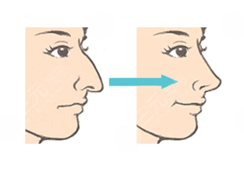 駝峰鼻矯正手術(shù)多少錢？