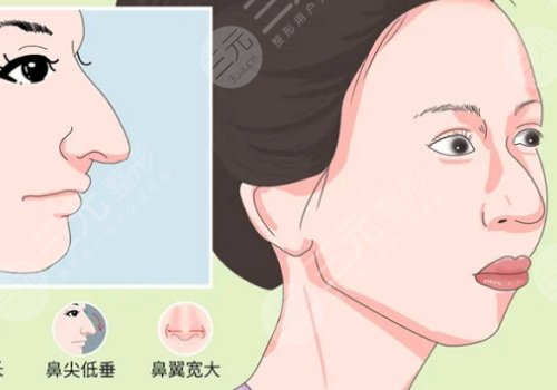 駝峰鼻矯正手術(shù)多少錢？