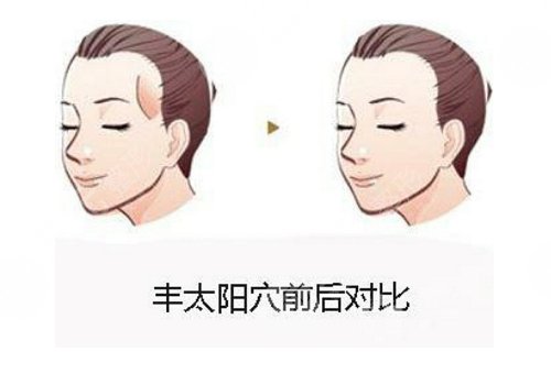 填充太陽(yáng)凹陷脂肪能保持多久?