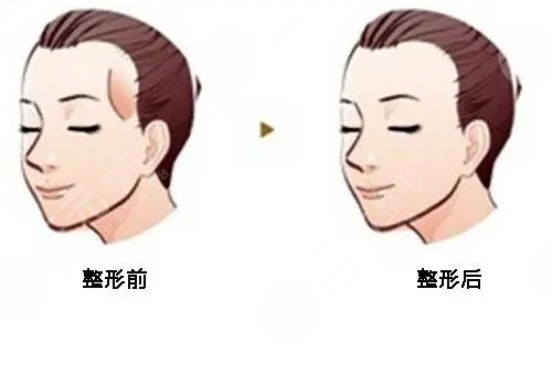 填充太陽(yáng)凹陷脂肪能保持多久?