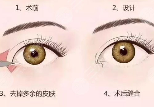 開(kāi)眼角加割雙眼皮一共多少錢(qián)?