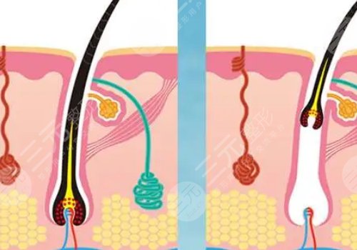 激光脫毛和冰點(diǎn)脫毛哪個(gè)好？