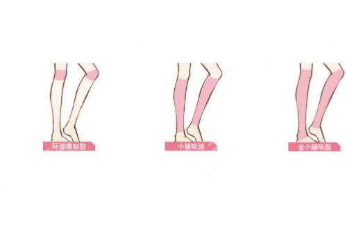 小腿吸脂恢復(fù)期要多久？有效果嗎？