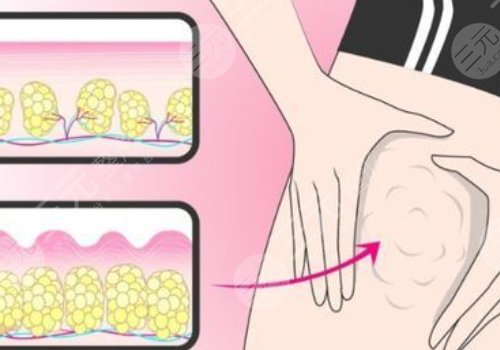 小腿吸脂恢復(fù)期要多久？有效果嗎？