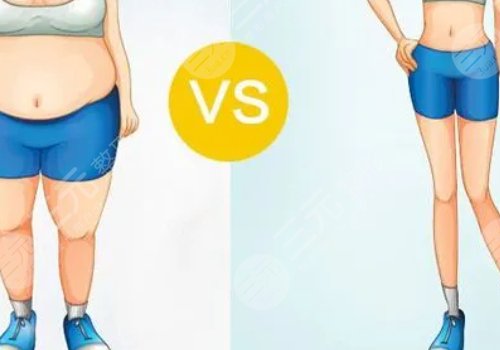 小腿吸脂恢復(fù)期要多久？有效果嗎？