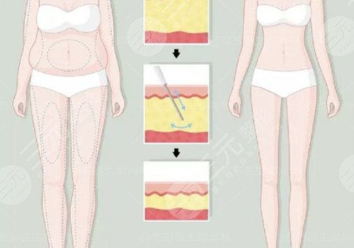 小腿吸脂恢復(fù)期要多久？有效果嗎？