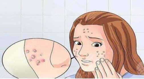 怎樣才能去除青春痘方法簡單有效？網(wǎng)友和網(wǎng)紅測評的8種小技巧，快來get